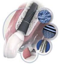 имплантация зубов казань