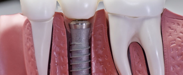 имплантация зуба в челюстную кость