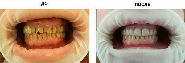 люминиры до и после