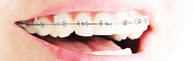 брекеты